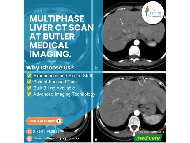 Multiphase Liver CT Scan at Butler Medical Imaging. (08) 9544 3999 photo 1