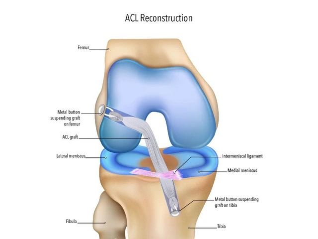 Torn ACL Surgery Begins with the Right Diagnosis photo 1