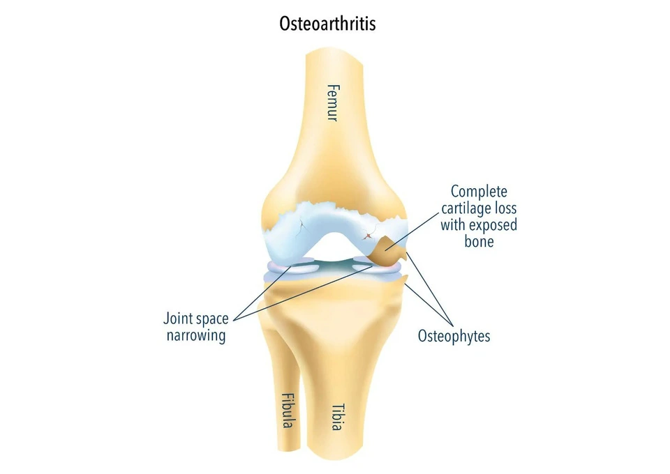 Arthritis Knee Treatment Options Worth Understanding First photo 1