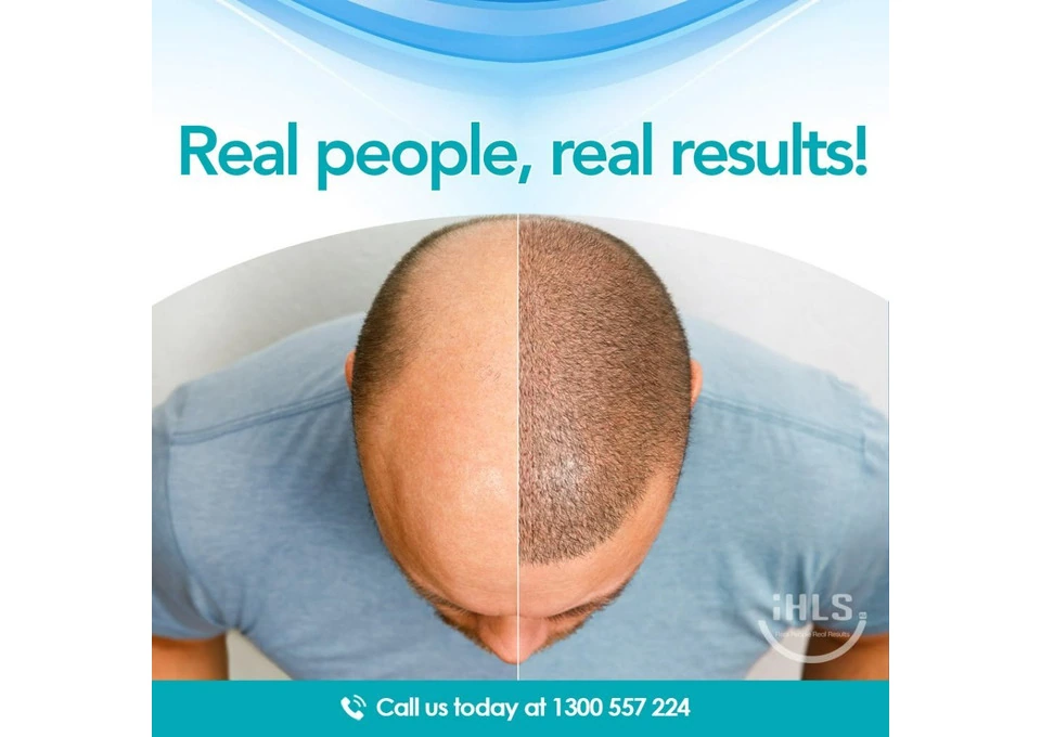 Real Success Stories and Inspiring Hair Loss Transformations in Perth photo 1