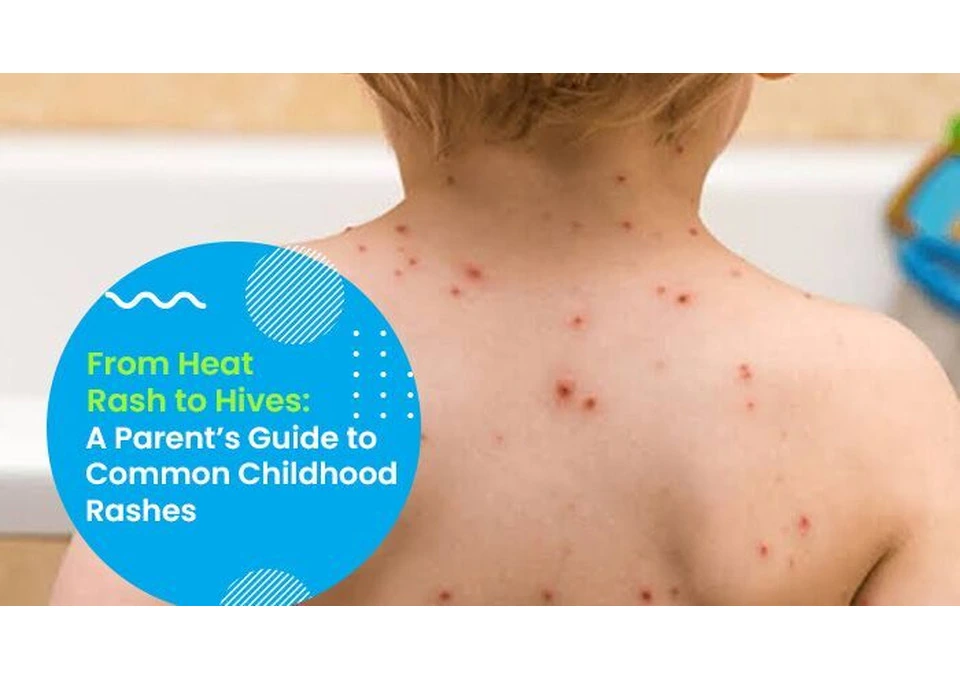 Learn About Common Childhood Rashes with Ashfield Child Care