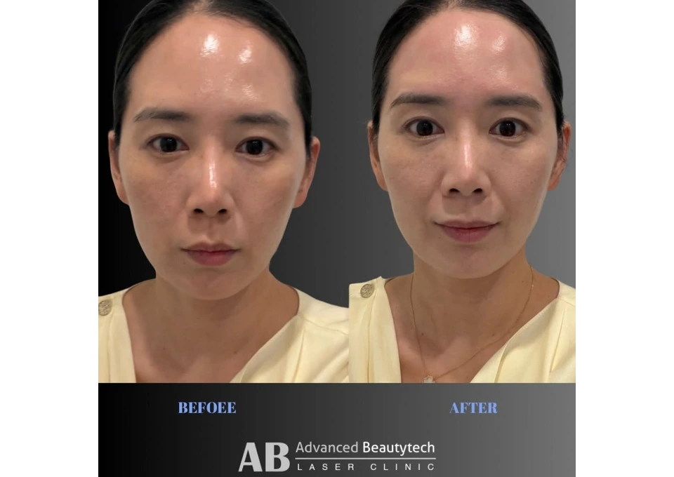 Hydrodermabrasion Balwyn | Advanced Beautytech Laser Clinic photo 1