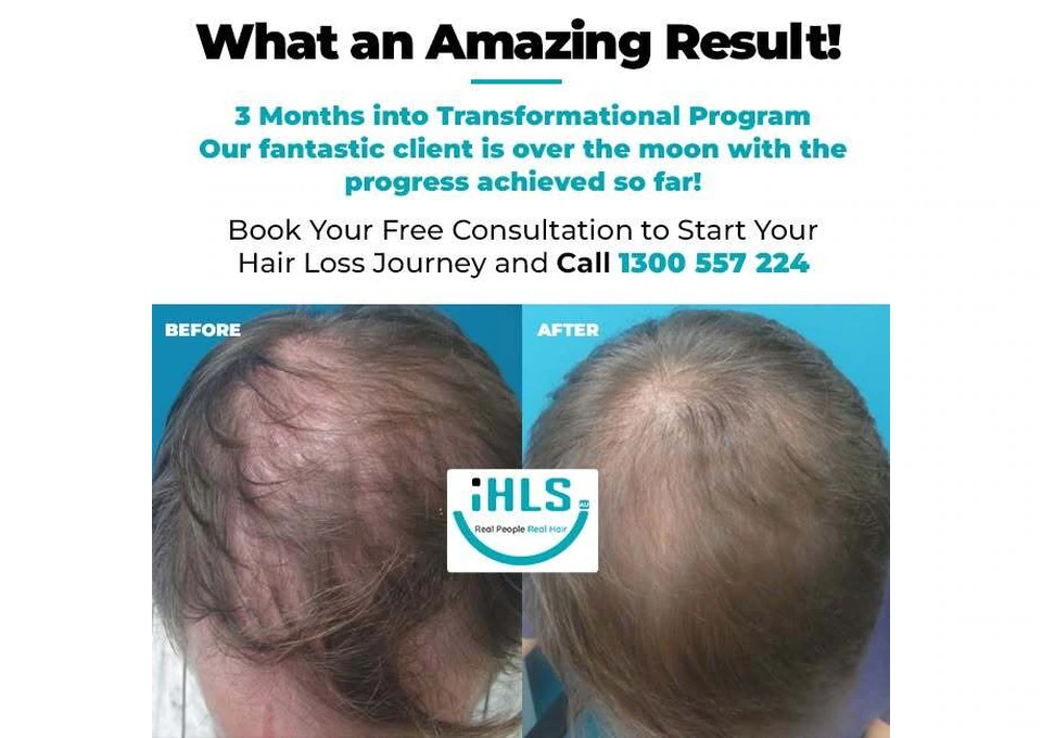 Explore Personalised Hair Restoration Transformations at IHLS photo 1