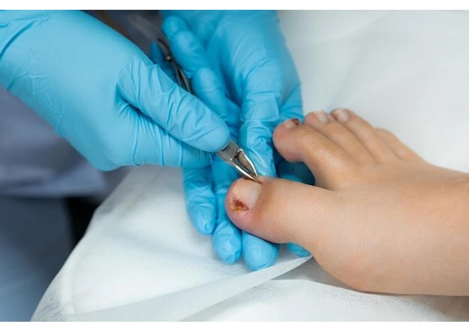 Get Relief with Ingrown Toenail Treatment in Black Rock photo 1