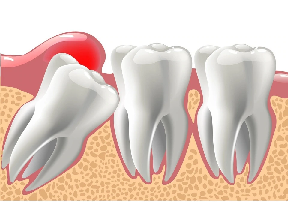 Looking For Wisdom Teeth Dentist Melbourne for Professional Dental Care? photo 1