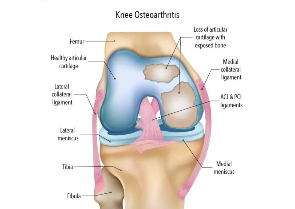 Improve Knee Function with Partial Knee Arthroplasty photo 1