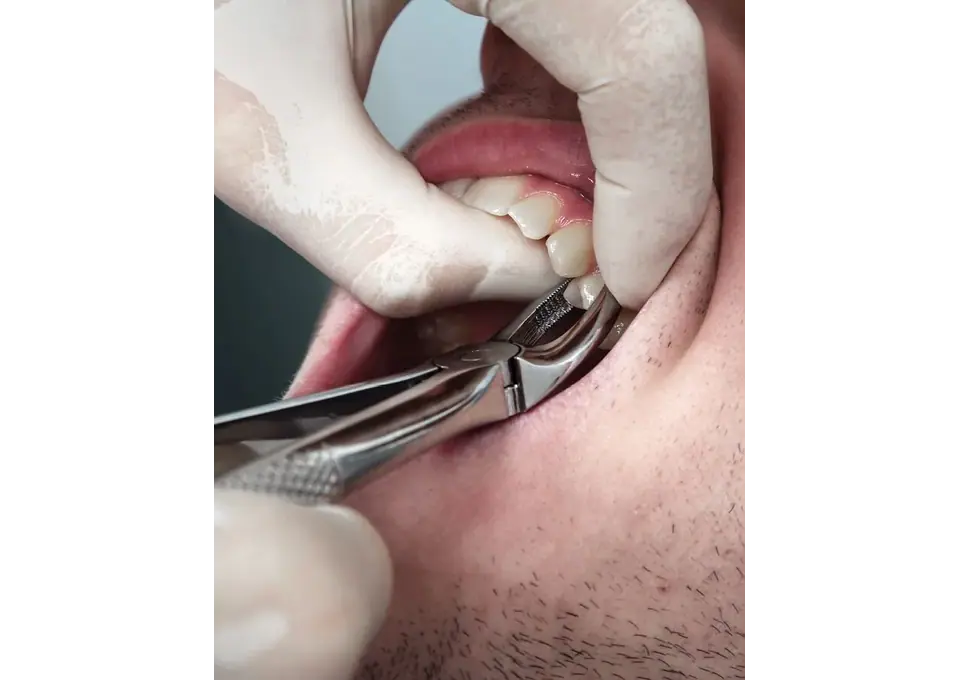 Checkout The Tooth Extraction Services of Dental Clinic Near Me Ormeau City photo 1
